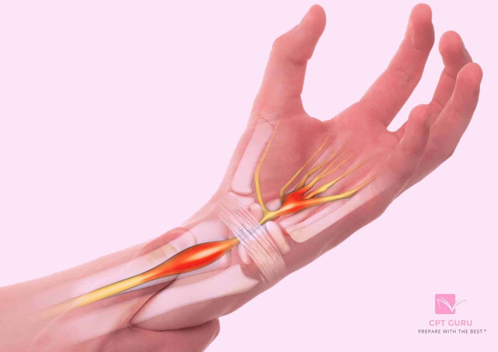 Carpel tunnel syndrome 